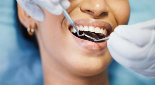 Best Emergency Dentist for Lost Fillings or Crowns in Endicott, NY